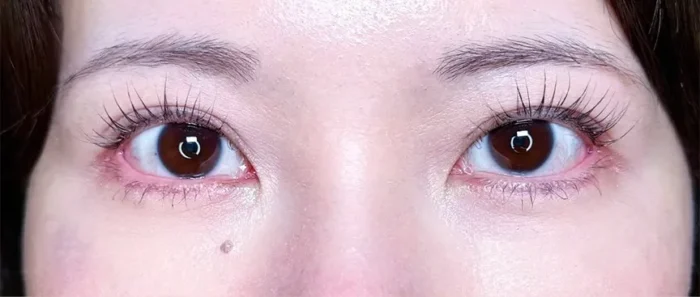 目元切開_目尻切開＋タレ目形成皮膚＋結膜術後1ヶ月（坂本優衣）（28）