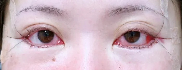 目元切開_目尻切開＋タレ目形成皮膚＋結膜術直後（坂本優衣）（28）