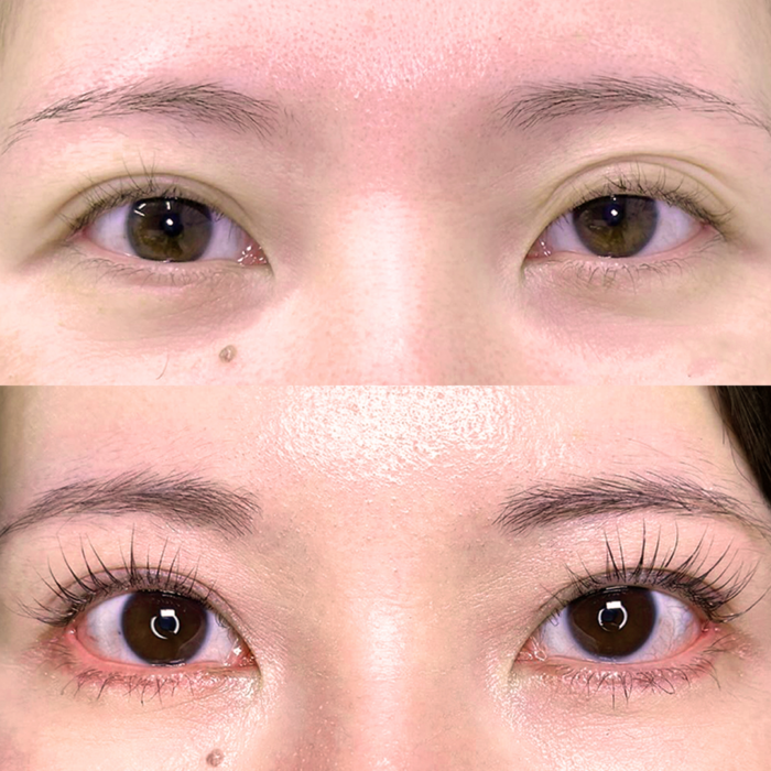 目元切開_目尻切開＋タレ目形成皮膚＋結膜（坂本優衣）（28）