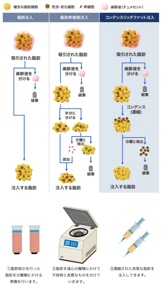 脂肪注入の濾過イメージ