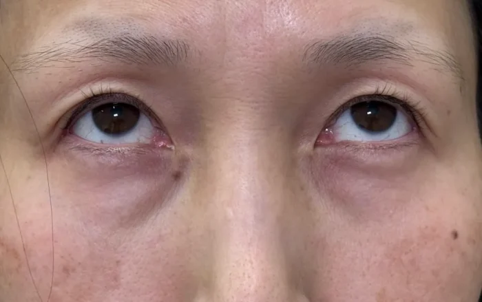 脱脂＋脂肪注入目上術前（名医の坂本優衣医師が執刀）（29）
