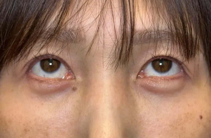 脱脂＋脂肪注入目上（名医の坂本優衣医師が執刀）（29）