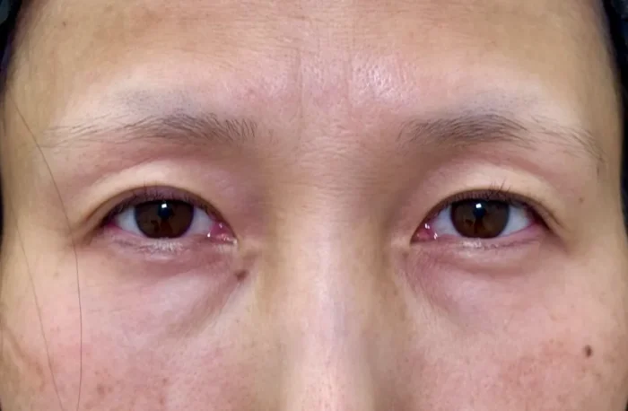 脱脂＋脂肪注入術前（名医の坂本優衣医師が執刀）（29）