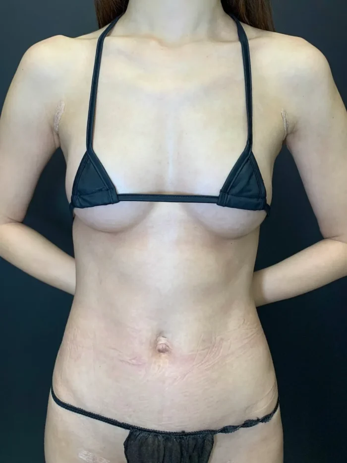 豊胸_ピュアグラフト1＋コンデンス2術後1ヶ月（田中里佳）（35）