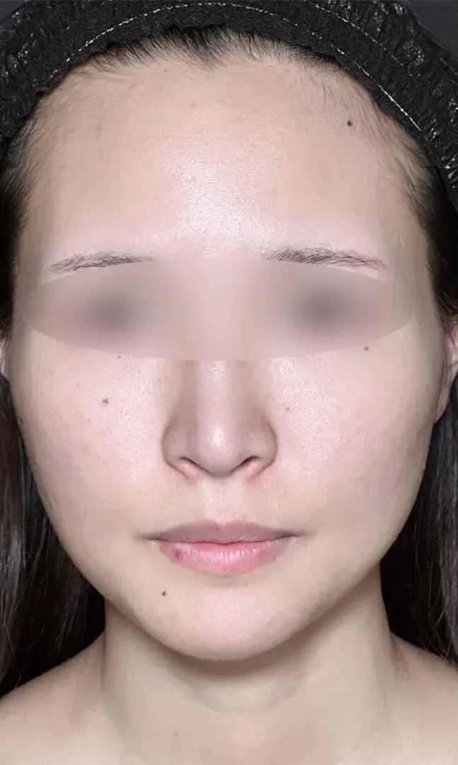 鼻尖形成オープン法＋鼻尖軟骨移植＋鼻プロテーゼ術前正面（名医の坂本優衣医師が執刀）（160）