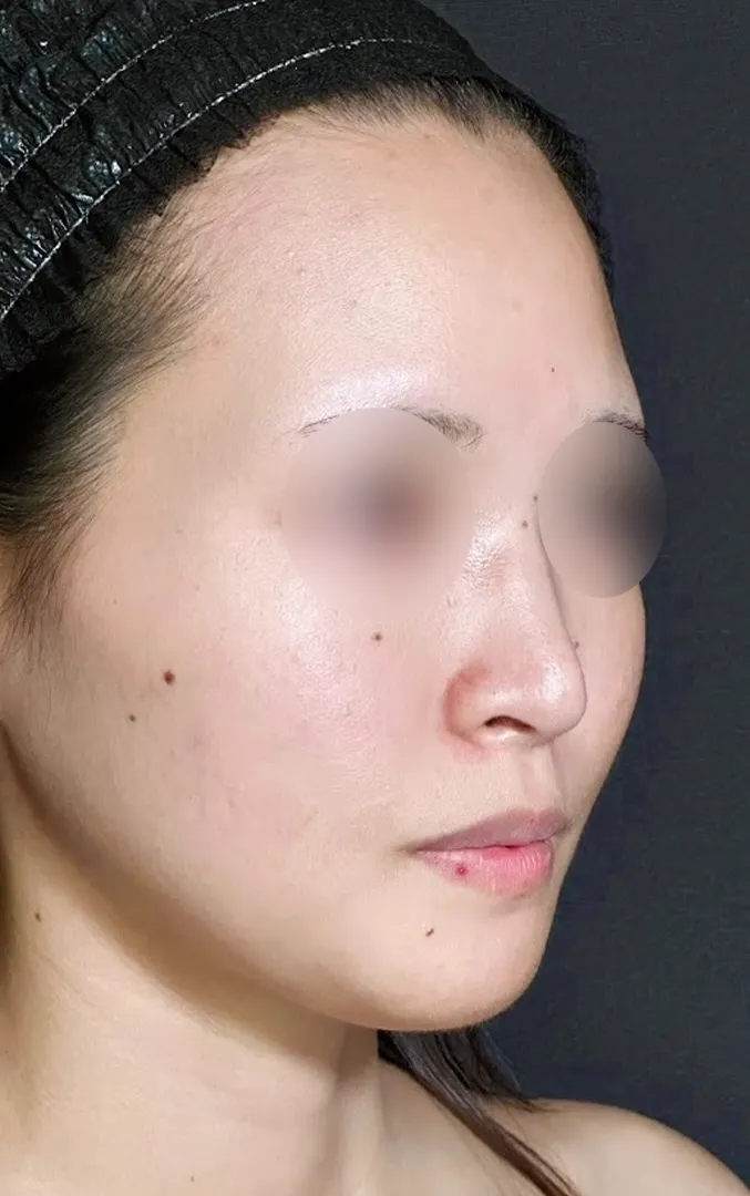 鼻尖形成オープン法＋鼻尖軟骨移植＋鼻プロテーゼ術前（名医の坂本優衣医師が執刀）（160）