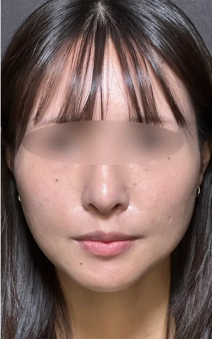 鼻尖形成オープン法＋鼻尖軟骨移植＋鼻プロテーゼ術後1ヶ月正面（名医の坂本優衣医師が執刀）（160）