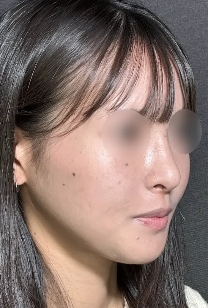 鼻尖形成オープン法＋鼻尖軟骨移植＋鼻プロテーゼ術後1ヶ月（名医の坂本優衣医師が執刀）（160）