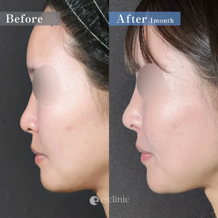 鼻尖形成オープン法＋鼻尖軟骨移植＋鼻プロテーゼ（名医の坂本優衣医師が執刀）（160）