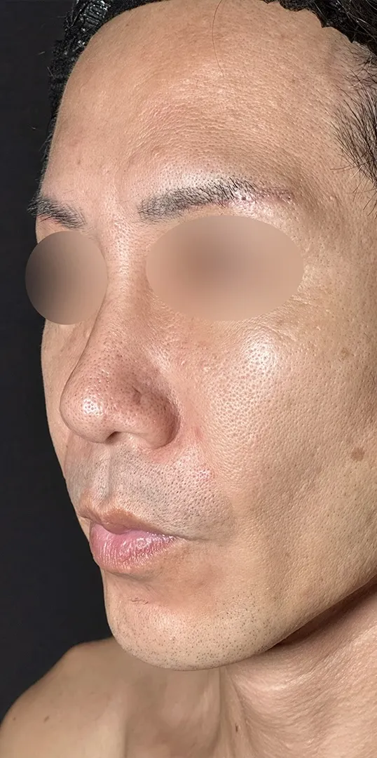 鼻整形_鼻尖形成オープン法+鼻尖軟骨移植+鼻プロテーゼ+鼻翼縮小内外側引き締め法術前横（坂本優衣）（158）