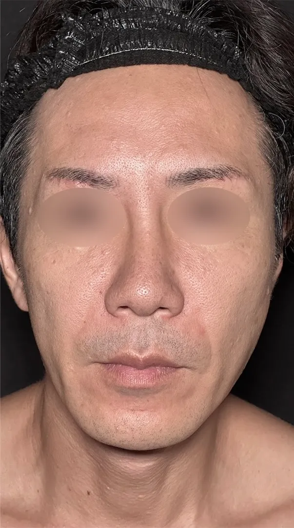 鼻整形_鼻尖形成オープン法+鼻尖軟骨移植+鼻プロテーゼ+鼻翼縮小内外側引き締め法術前（坂本優衣）（158）