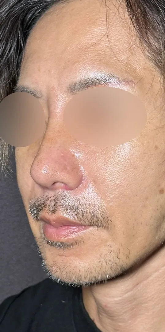 鼻整形_鼻尖形成オープン法+鼻尖軟骨移植+鼻プロテーゼ+鼻翼縮小内外側引き締め法術後1ヶ月横（坂本優衣）（158）