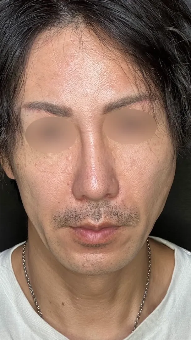 鼻整形_鼻尖形成オープン法+鼻尖軟骨移植+鼻プロテーゼ+鼻翼縮小内外側引き締め法術後1ヶ月（坂本優衣）（158）