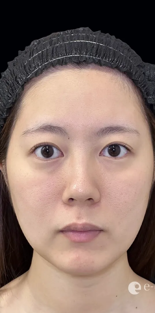 鼻整形_鼻尖形成オープン法＋鼻尖軟骨移植＋鼻柱下降術前（坂本優衣）（159）