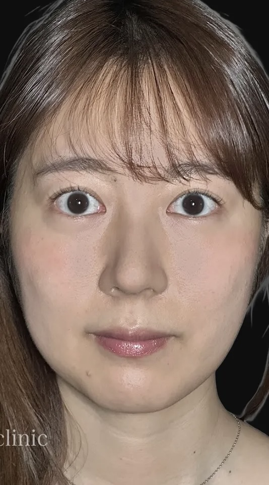 鼻整形_鼻尖形成オープン法＋鼻尖軟骨移植＋鼻柱下降術後（坂本優衣）（159）