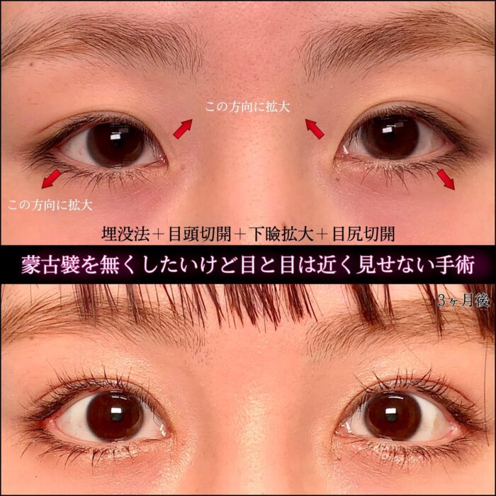 埋没法と目頭切開とタレ目形成と目尻切開の症例写真