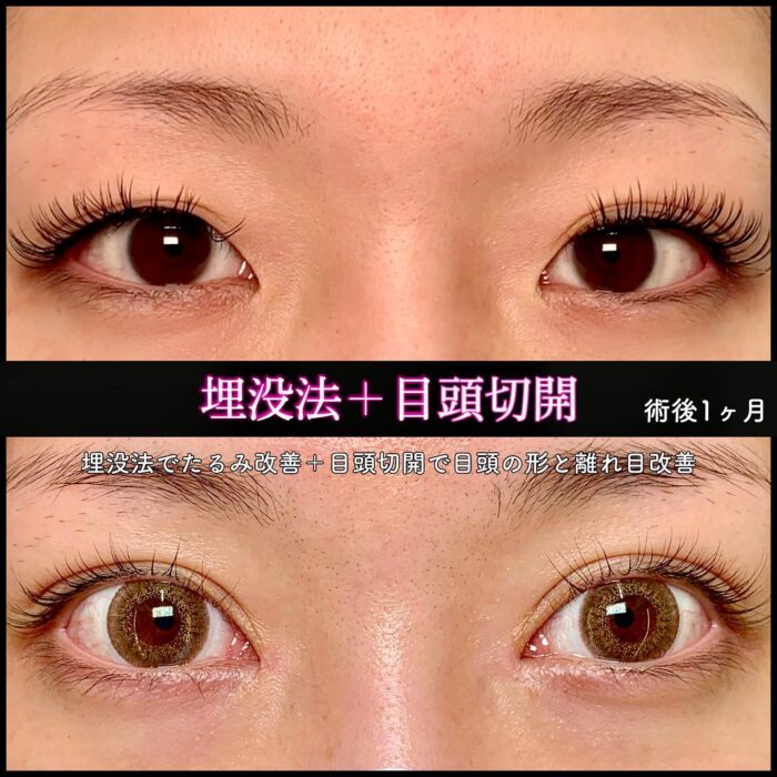 埋没法と目頭切開の症例写真 (2)