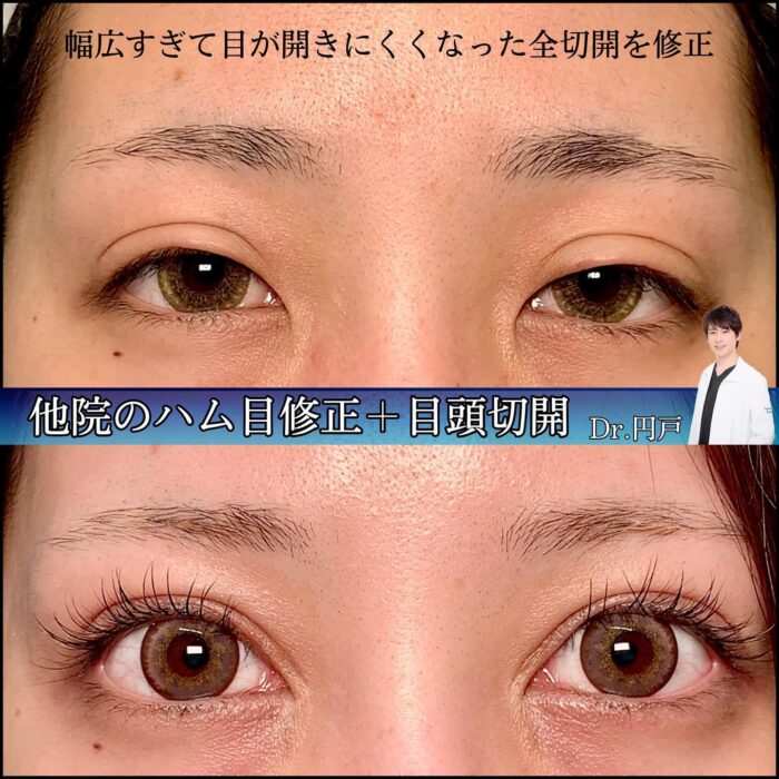 目元の他院修正と目頭切開の症例写真