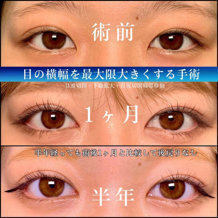 目頭切開と下瞼拡大と目尻靭帯移動の症例写真 (1)