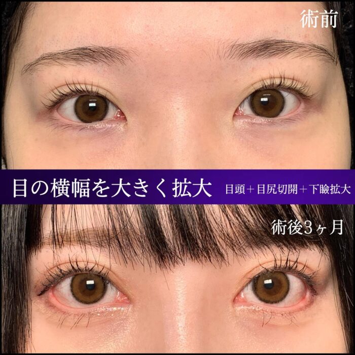 目頭切開と目尻切開とグラマラスライン形成の症例写真