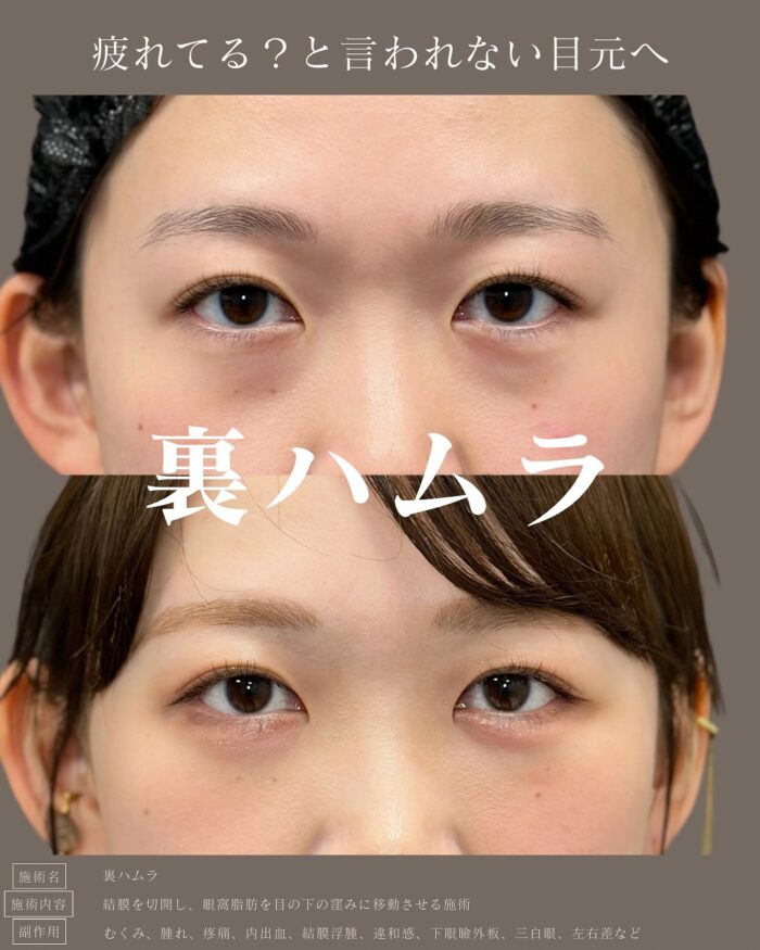 裏ハムラ法（名古屋の名医の服部健人医師が執刀）