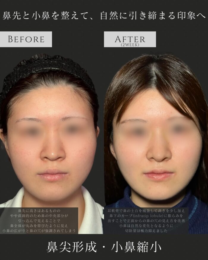 鼻尖形成(3D法)_耳介軟骨移植_小鼻縮小(内外側法)(大阪の名医の服部健人医師が執刀)