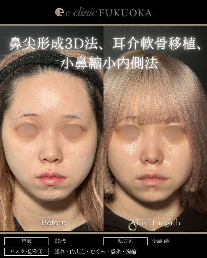 鼻尖形成3D法_耳介軟骨移植_小鼻縮小内側法（福岡の名医の伊藤渉医師が執刀）