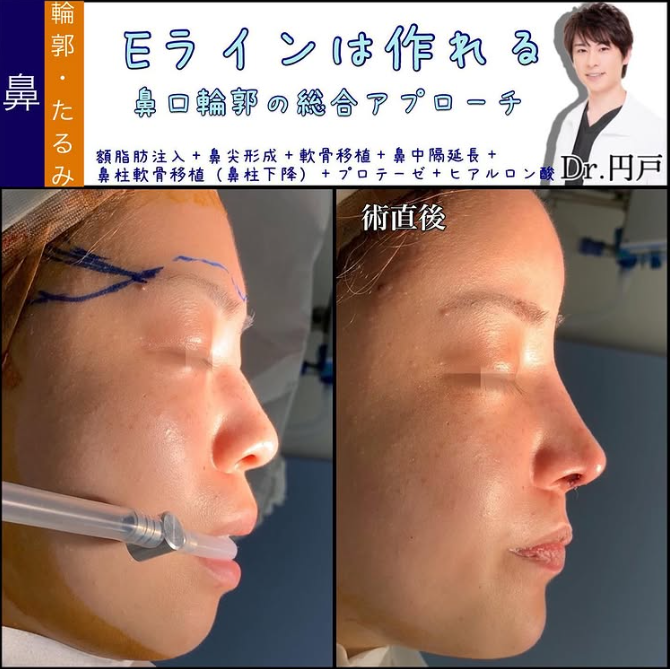 鼻尖形成_軟骨移植_鼻中隔延長_鼻柱下降_プロテーゼ_ヒアルロン酸_額脂肪注入（福岡の名医の円戸望医師が執刀）