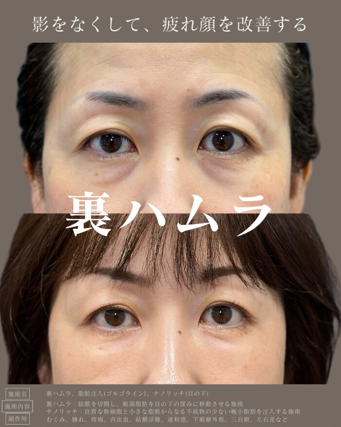裏ハムラ法（名古屋の名医の服部健人医師が執刀）