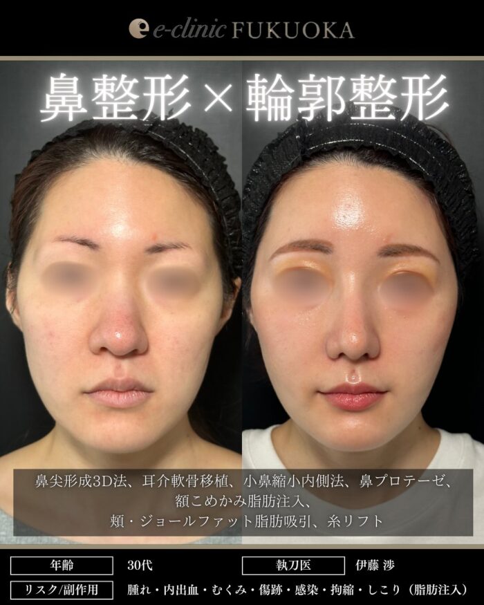 鼻尖形成3D法_耳介軟骨移植_小鼻縮小内側法_鼻プロテーゼ、額こめかみ脂肪注入_頬・ジョールファット脂肪吸引_糸リフト（福岡の名医の伊藤渉医師が執刀）