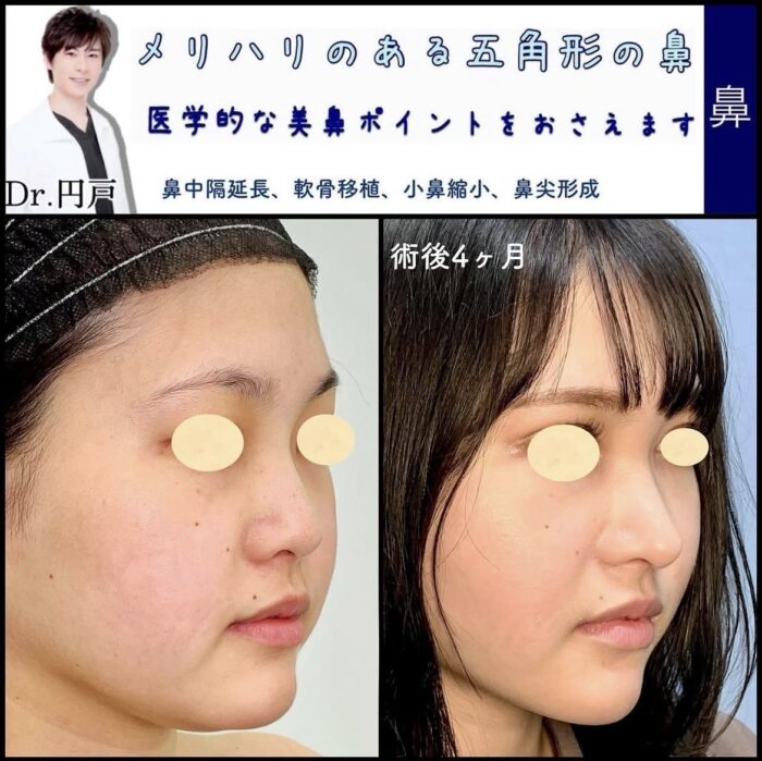 小鼻縮小＋鼻中隔延長＋軟骨移植＋鼻尖形成（福岡の名医の円戸望医師が執刀）
