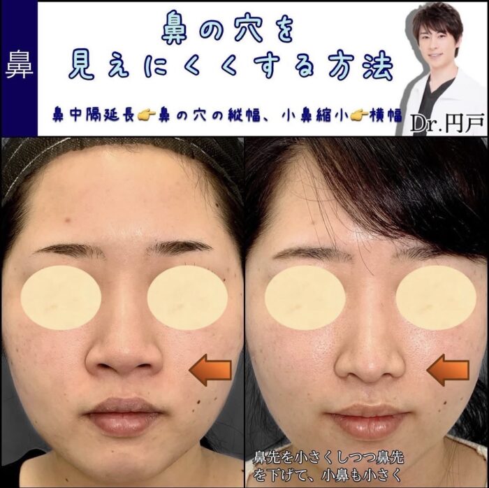 小鼻縮小＋鼻中隔延長（福岡の名医の円戸望医師が執刀）