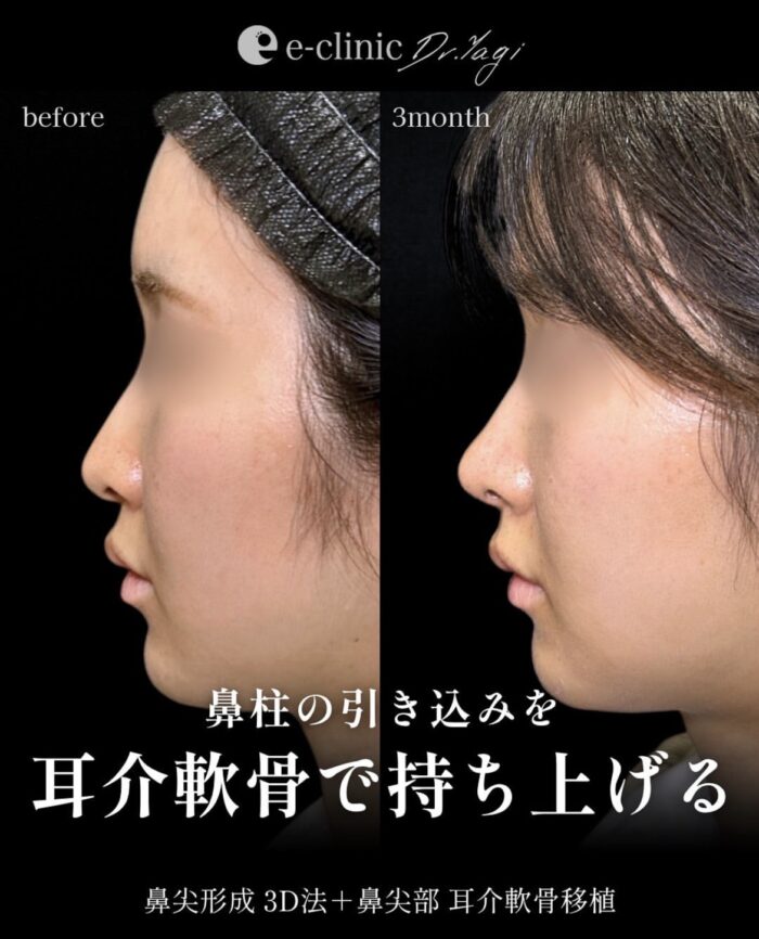 鼻尖形成(3D法)_耳介軟骨移植（大阪の名医の八木良太医師が執刀）