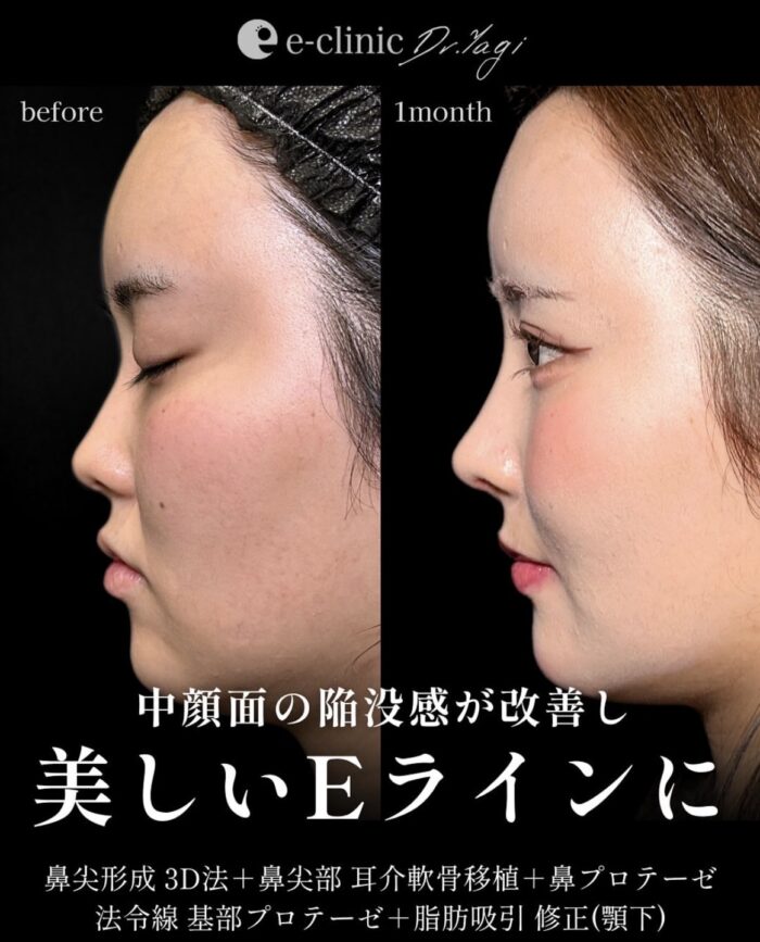 鼻尖形成(3D法)_耳介軟骨移植_鼻プロテーゼ_法令線（鼻翼基部）プロテーゼ(貴族手術)_Ultra-Z 小顔脂肪吸引 1部位（大阪の名医の八木良太医師が執刀）