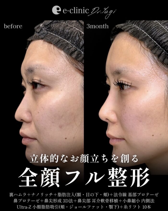 鼻尖形成(3D法)_耳介軟骨移植_鼻プロテーゼ_小鼻縮小 内側法_小鼻縮小 引き締め縫合_法令線（鼻翼基部）プロテーゼ(貴族手術)_小顔スタンダードプラン_裏ハムラ法_ナノリッチ脂肪注入（目の下）（大阪の名医の八木良太医師が執刀）