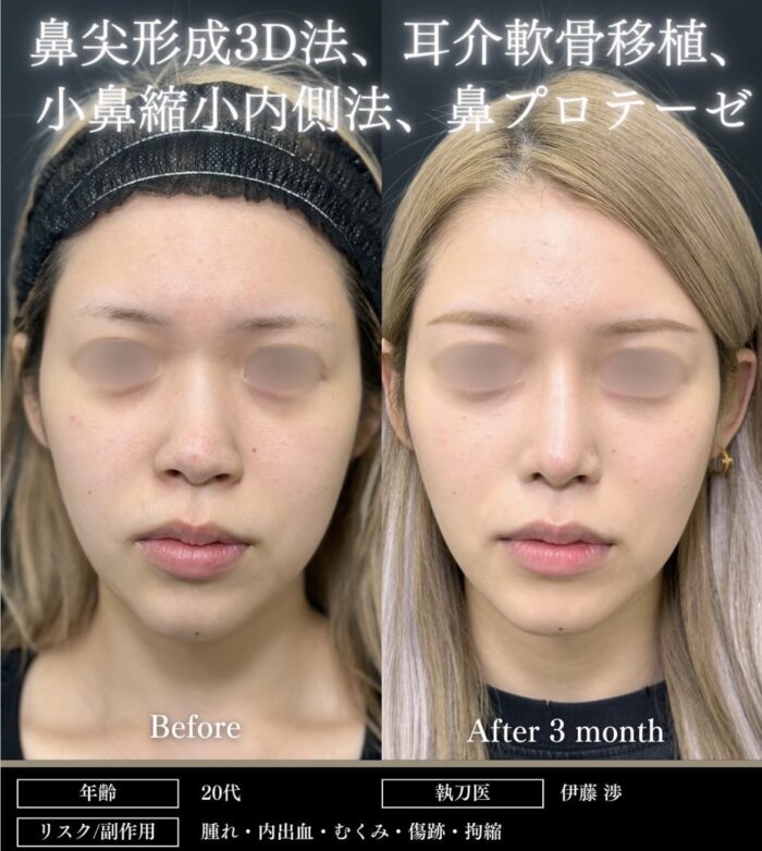 鼻尖形成3D法_耳介軟骨移植_小鼻縮小内側法＋引き締め縫合_鼻プロテーゼ(I型)（福岡の名医の伊藤渉医師が執刀）