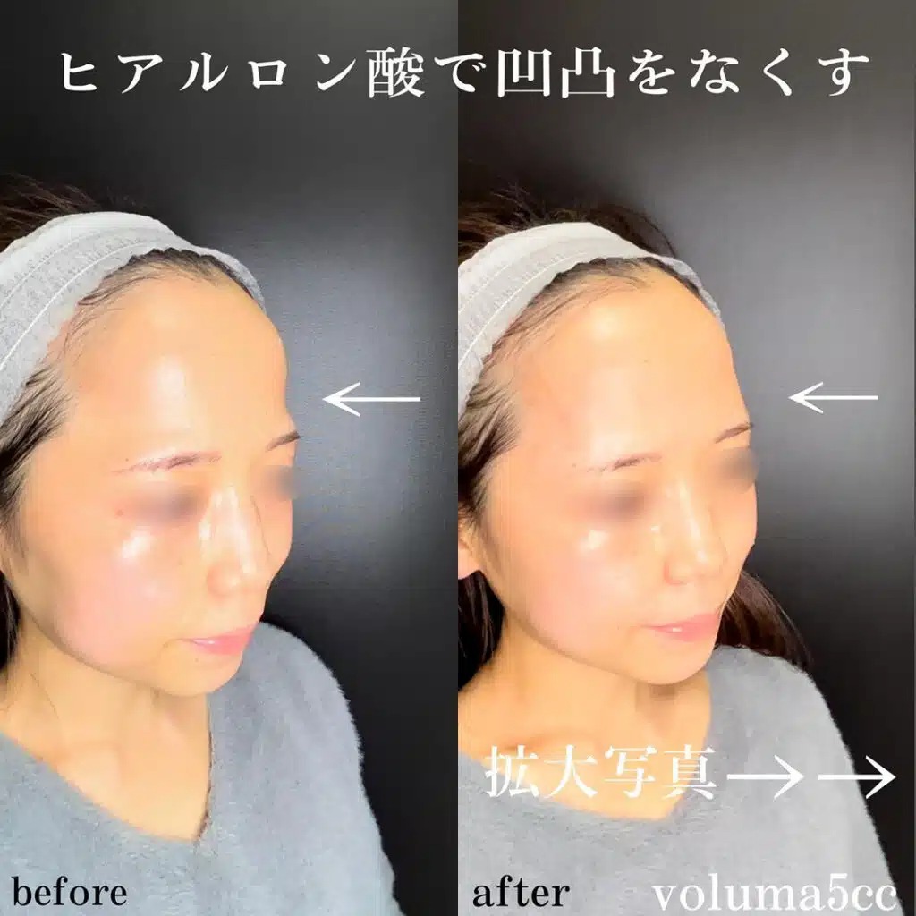 おでこのヒアルロン酸の症例写真