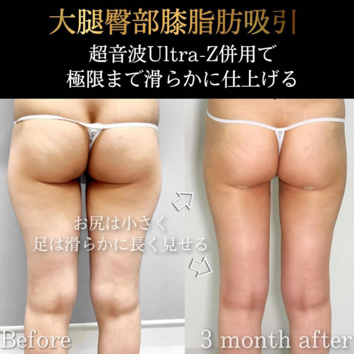 お尻の脂肪吸引の症例写真