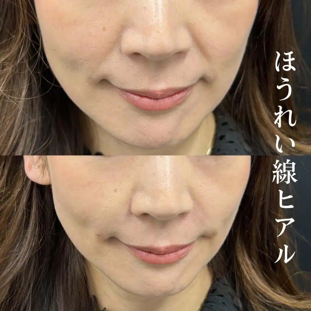ほうれい線のヒアルロン酸の症例写真