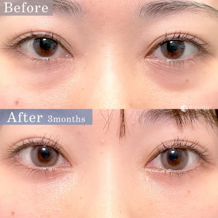 クマ取り_裏ハムラ法（内固定オプション、ナノリッチ）（脇谷雄一朗）（110）