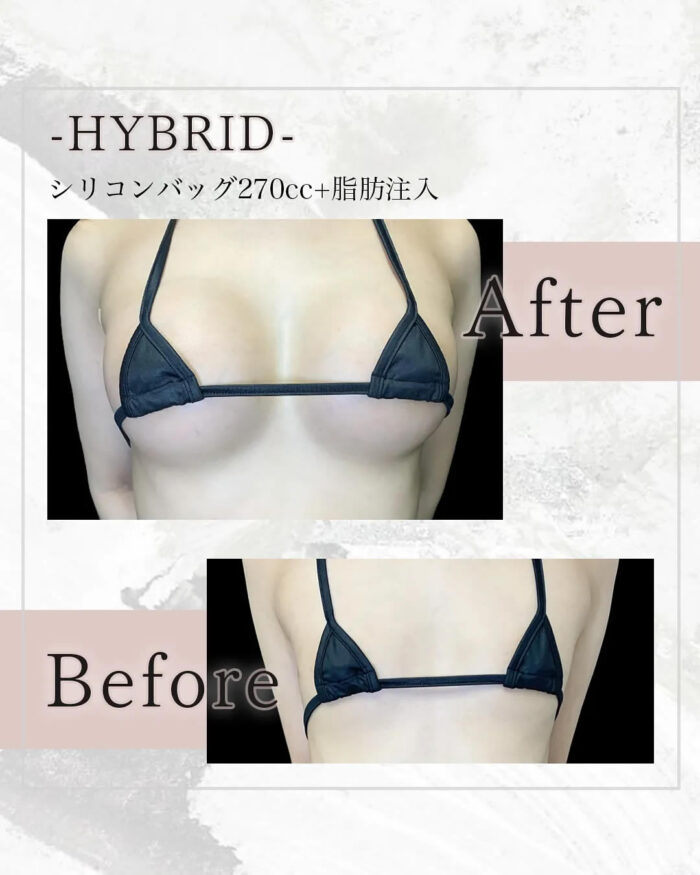 シリコンバッグ270ccと脂肪注入の症例写真