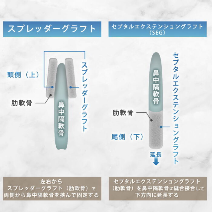 スプレッダーグラフトとセプタルエクステンショングラフトの違い