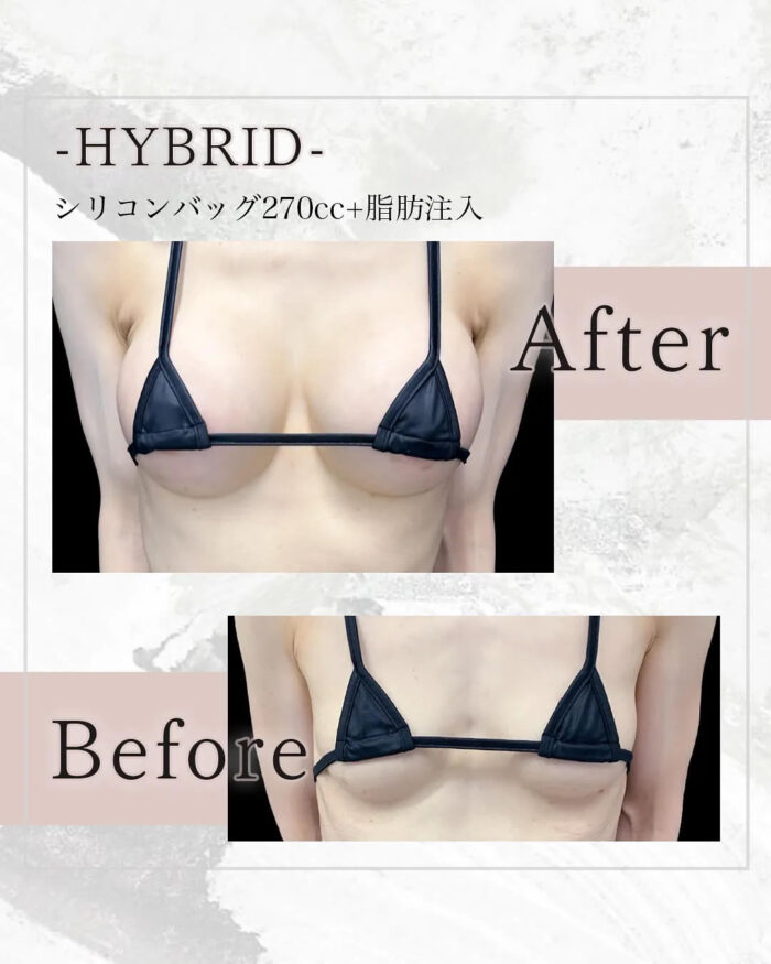 ハイブリット豊胸の症例写真