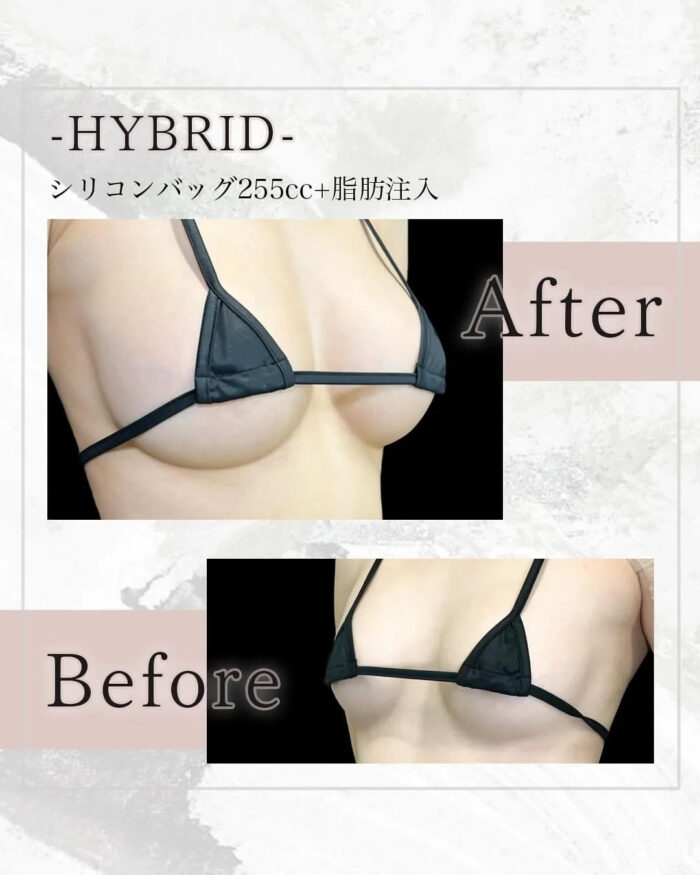 ハイブリット豊胸を受けた20代の症例写真
