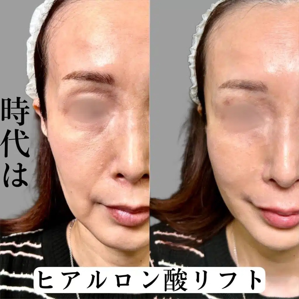 ヒアルロン酸リフトの症例写真