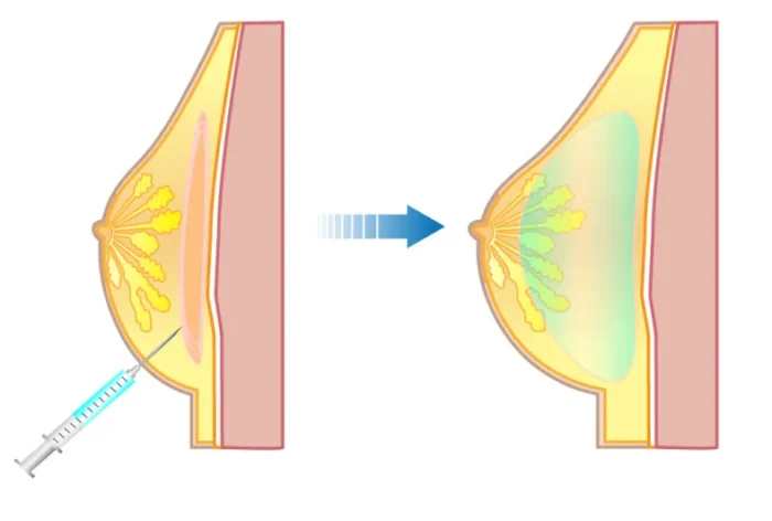 ヒアルロン酸豊胸の図解