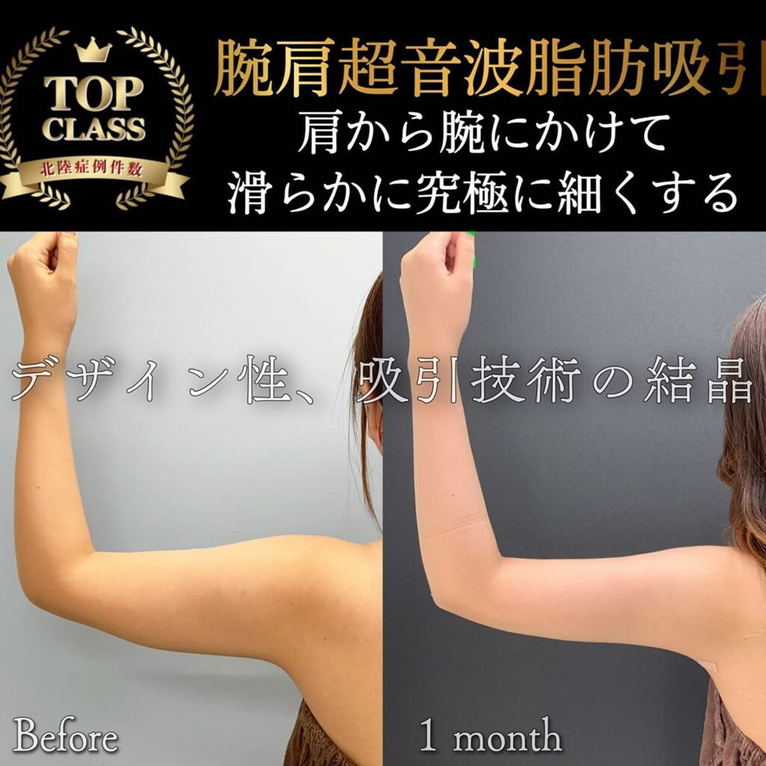 二の腕の脂肪吸引 (2)