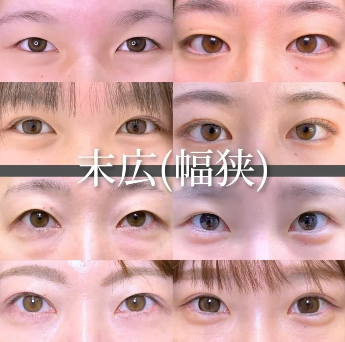 二重症例一覧のデザイン（末広幅狭）