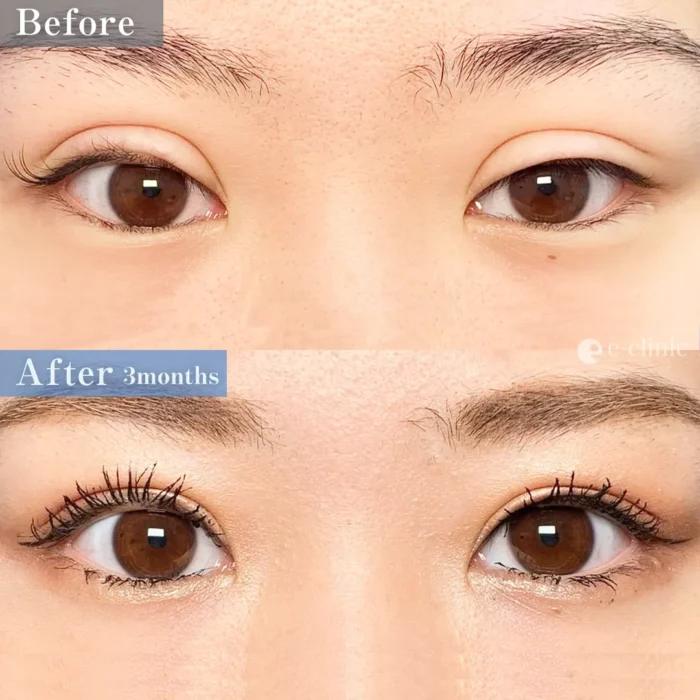 二重全切開ハム目他院修正（円戸望）（199）