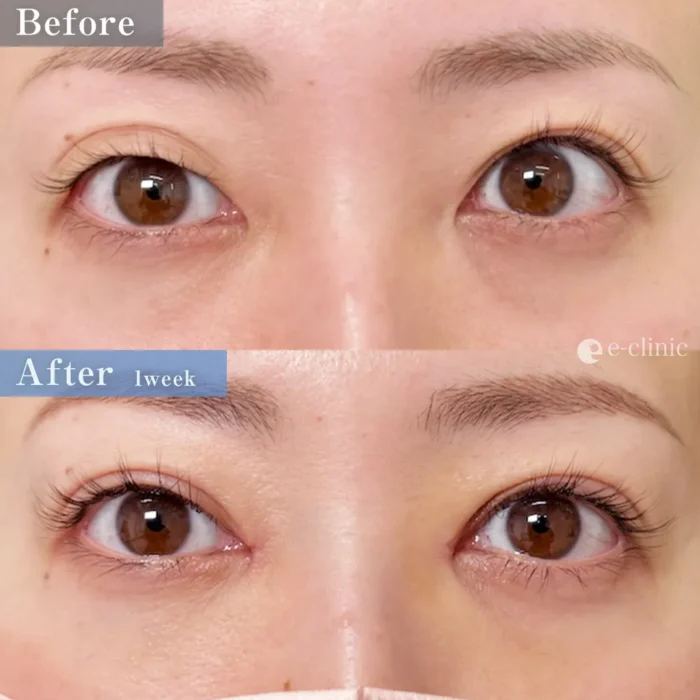 二重埋没_特殊6点裏留め（他院修正）（伊藤渉）（65）